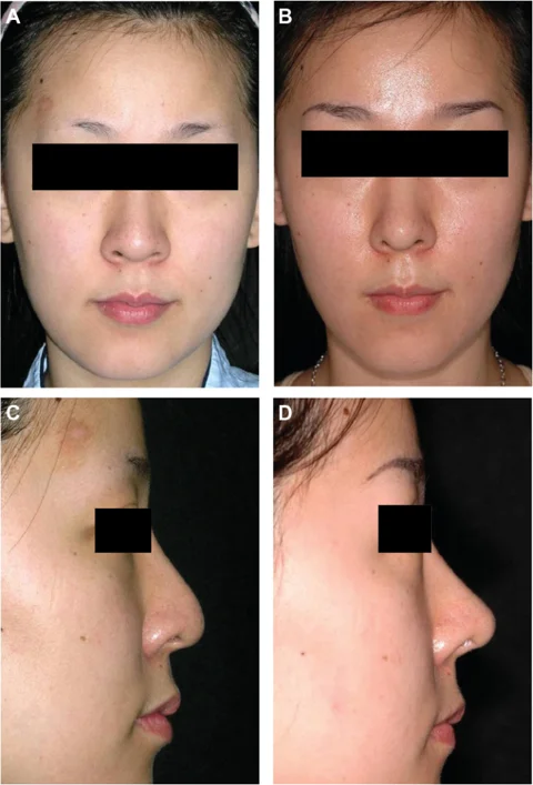 Nasal tip support: an 18-month comparison at IBON Plastic Surgery. Figure 5 from Kim and colleagues (2012): front and profile views, before on the left and 18 months after surgery on the right. Eye regions are covered for privacy.