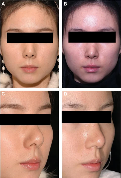 Revision supratip soft-tissue correction: 25 months at IBON Plastic Surgery. Figure 6 from Kim and colleagues (2012): front and angled views, before on the left and 25 months after surgery on the right. Eye regions are covered for privacy.