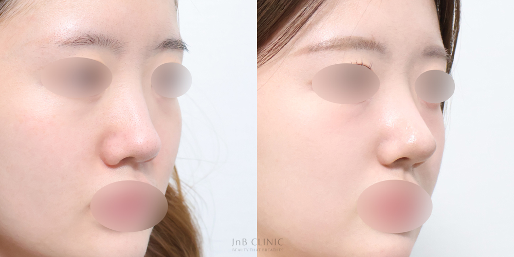 Bridge and tip in an oblique view at JNB Clinic. JNB Clinic nose surgery comparison 01: bridge and tip in an oblique view. Paired clinic-supplied photographs with the original eye and mouth obscuring retained.