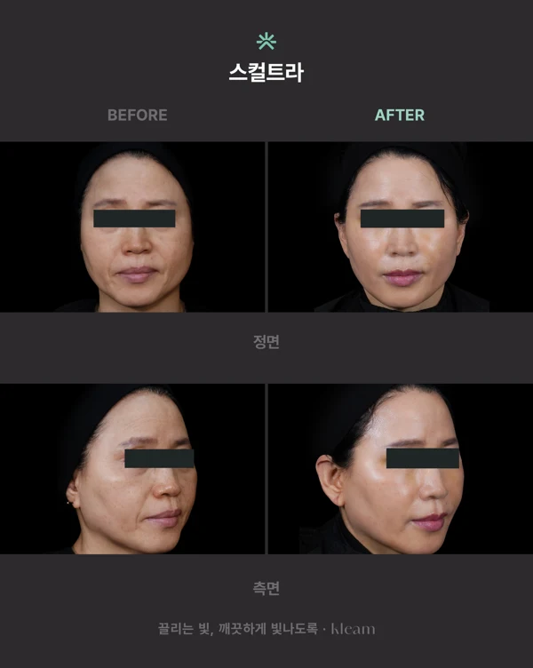 Sculptra: front and angled facial comparisons at Kleam Clinic Myeongdong. Sculptra comparison from Kleam Clinic Myeongdong: before on the left and after on the right, with front views above and angled views below. Eyes are covered; follow-up timing is not supplied.