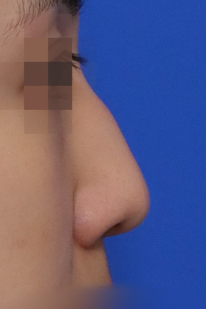 Nasal hump and deviation correction — 2 weeks at Kobijou Rhinoplasty Clinic. Side