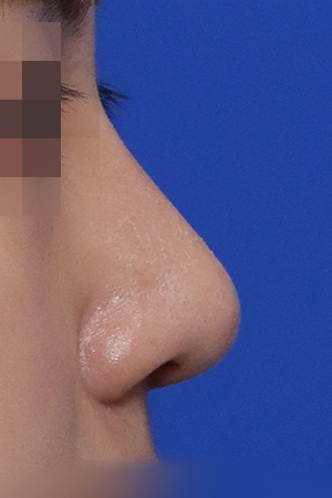 Nasal hump and deviation correction — 2 weeks at Kobijou Rhinoplasty Clinic. Side