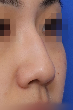 Nasal hump and deviation correction — 2 weeks at Kobijou Rhinoplasty Clinic. Oblique