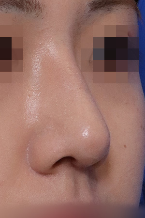Nasal hump and deviation correction — 2 weeks at Kobijou Rhinoplasty Clinic. Oblique