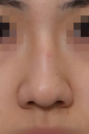 Nasal hump and deviation correction — 2 weeks at Kobijou Rhinoplasty Clinic. Front