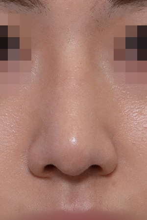 Nasal hump and deviation correction — 2 weeks at Kobijou Rhinoplasty Clinic. Front