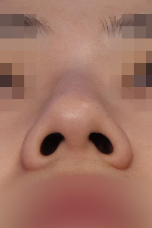 Nasal hump and deviation correction — 2 weeks at Kobijou Rhinoplasty Clinic. Nasal base