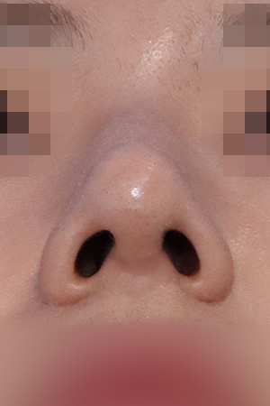 Nasal hump and deviation correction — 2 weeks at Kobijou Rhinoplasty Clinic. Nasal base