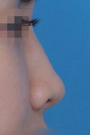 Saddle nose reconstruction — 4 months at Kobijou Rhinoplasty Clinic. Side