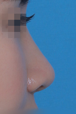 Saddle nose reconstruction — 4 months at Kobijou Rhinoplasty Clinic. Side