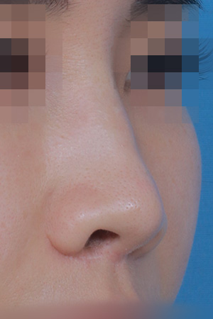 Saddle nose reconstruction — 4 months at Kobijou Rhinoplasty Clinic. Oblique
