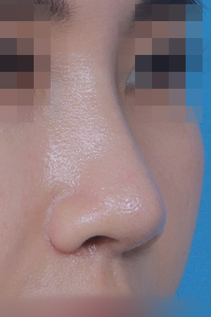 Saddle nose reconstruction — 4 months at Kobijou Rhinoplasty Clinic. Oblique