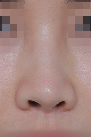 Saddle nose reconstruction — 4 months at Kobijou Rhinoplasty Clinic. Front