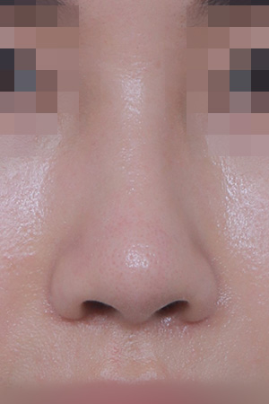 Saddle nose reconstruction — 4 months at Kobijou Rhinoplasty Clinic. Front
