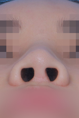 Saddle nose reconstruction — 4 months at Kobijou Rhinoplasty Clinic. Nasal base