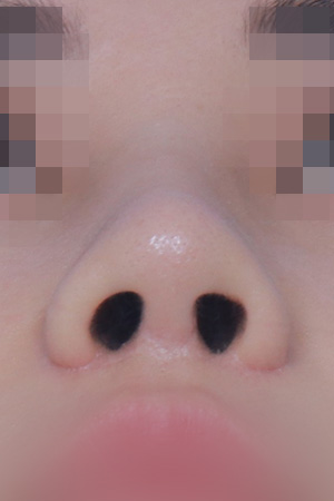 Saddle nose reconstruction — 4 months at Kobijou Rhinoplasty Clinic. Nasal base