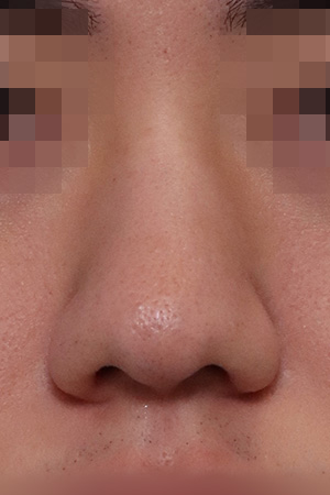 Deviated nose and bulbous tip correction — 3 weeks at Kobijou Rhinoplasty Clinic. Front