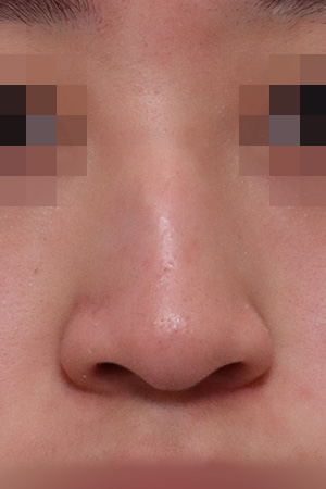 Nasal hump and deviation correction — 2 weeks at Kobijou Rhinoplasty Clinic. Front