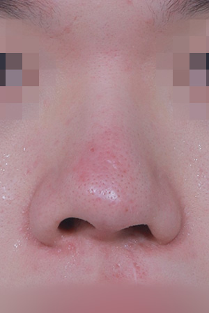 Cleft lip nose correction — 6 months at Kobijou Rhinoplasty Clinic. Front
