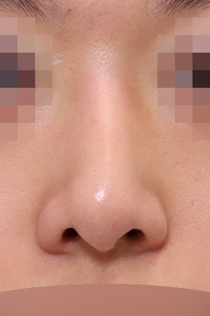 Revision rhinoplasty with implant removal — 6 months at Kobijou Rhinoplasty Clinic. Front