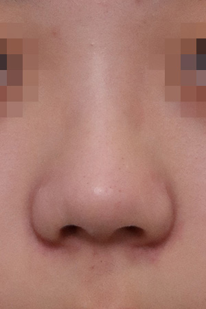 Bulbous tip correction with bridge augmentation — 2 weeks at Kobijou Rhinoplasty Clinic. Front