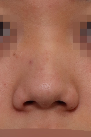 Bulbous tip correction with alar reduction — 2 weeks at Kobijou Rhinoplasty Clinic. Front