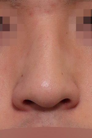 Nasal hump and deviation correction — 2 weeks at Kobijou Rhinoplasty Clinic. Front