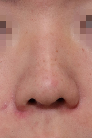 Nasal hump correction with a nasal root graft — 2 weeks at Kobijou Rhinoplasty Clinic. Front