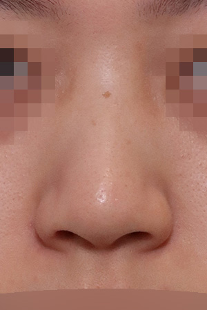 Bulbous tip correction — 4 months at Kobijou Rhinoplasty Clinic. Front