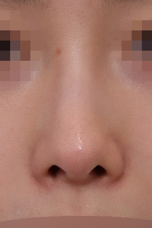 Deviated nose correction with implant removal — 2 weeks at Kobijou Rhinoplasty Clinic. Front