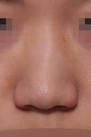 Saddle nose and deviation correction — 2 weeks at Kobijou Rhinoplasty Clinic. Front