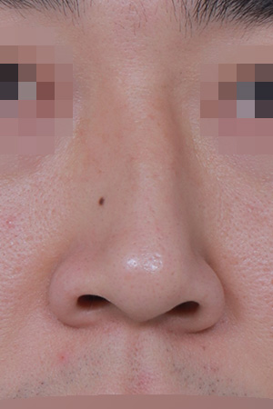 Nasal deviation and hump correction — 3 months at Kobijou Rhinoplasty Clinic. Front