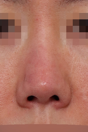 Saddle nose reconstruction with septal repair — 1 month at Kobijou Rhinoplasty Clinic. Front