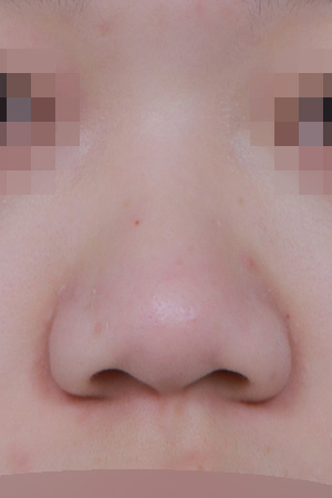 Low bridge and bulbous tip correction — 1 month at Kobijou Rhinoplasty Clinic. Front
