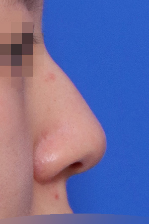 Hump, deviation and bulbous tip correction — 2 weeks at Kobijou Rhinoplasty Clinic. Side