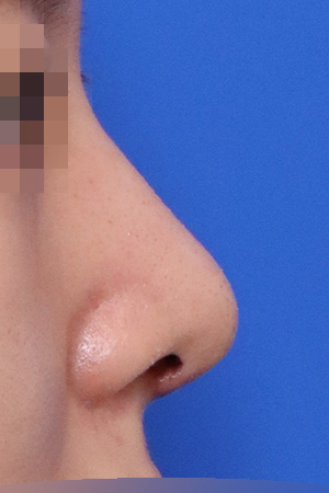 Hump, deviation and bulbous tip correction — 2 weeks at Kobijou Rhinoplasty Clinic. Side