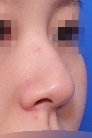 Hump, deviation and bulbous tip correction — 2 weeks at Kobijou Rhinoplasty Clinic. Oblique