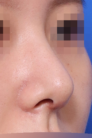 Hump, deviation and bulbous tip correction — 2 weeks at Kobijou Rhinoplasty Clinic. Oblique