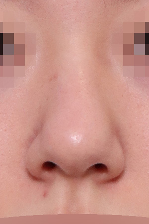 Hump, deviation and bulbous tip correction — 2 weeks at Kobijou Rhinoplasty Clinic. Front
