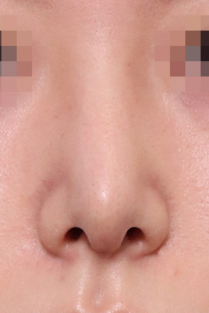 Hump, deviation and bulbous tip correction — 2 weeks at Kobijou Rhinoplasty Clinic. Front