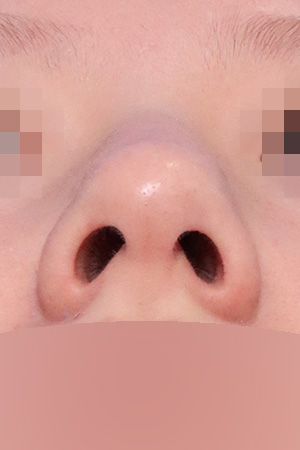 Hump, deviation and bulbous tip correction — 2 weeks at Kobijou Rhinoplasty Clinic. Nasal base