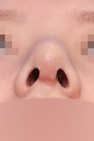 Hump, deviation and bulbous tip correction — 2 weeks at Kobijou Rhinoplasty Clinic. Nasal base