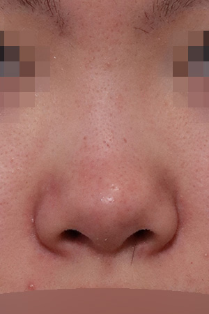 Low nasal bridge augmentation — 2 weeks at Kobijou Rhinoplasty Clinic. Front