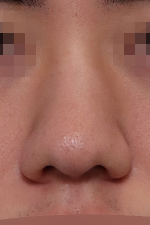 Deviated nose correction with alar reduction — 1 month at Kobijou Rhinoplasty Clinic. Front