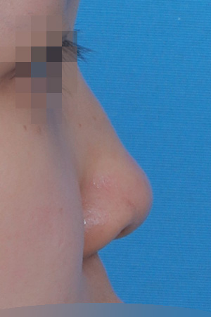 Low bridge and bulbous tip correction — 1 year at Kobijou Rhinoplasty Clinic. Side