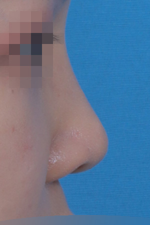 Low bridge and bulbous tip correction — 1 year at Kobijou Rhinoplasty Clinic. Side