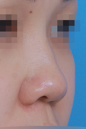 Low bridge and bulbous tip correction — 1 year at Kobijou Rhinoplasty Clinic. Oblique