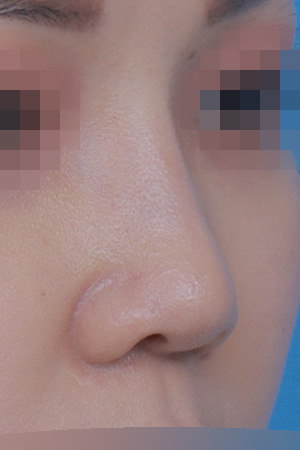 Low bridge and bulbous tip correction — 1 year at Kobijou Rhinoplasty Clinic. Oblique