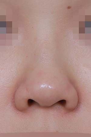 Low bridge and bulbous tip correction — 1 year at Kobijou Rhinoplasty Clinic. Front