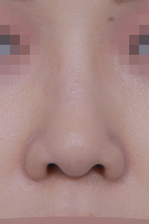Low bridge and bulbous tip correction — 1 year at Kobijou Rhinoplasty Clinic. Front